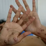 Mpox o ‘viruela del mono’: cómo se transmite, cuáles son los síntomas y todo lo que debes saber sobre la enfermedad