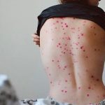 Viruela del mono: Minsa emite alerta epidemiológica en centros de salud por ingreso de enfermedad a Perú